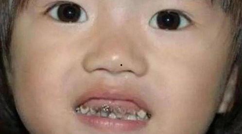 吃瓜引发牙炎,口腔健康需重视